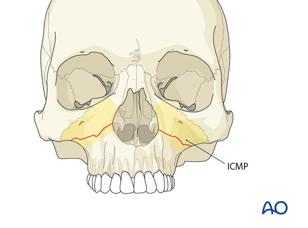 AOCMF Classification Midface (Level 1 and 2)