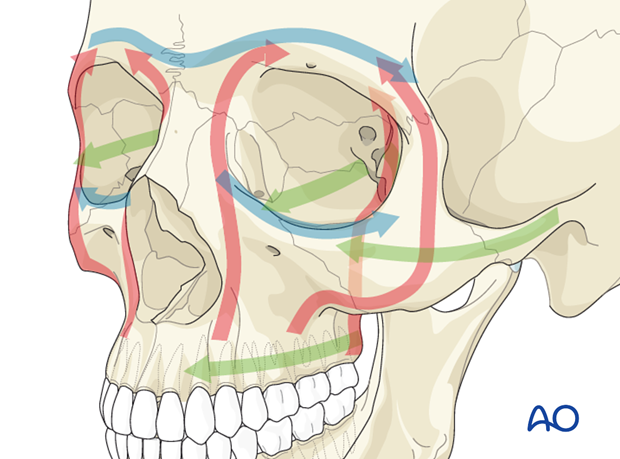 panfacial fractures sequencing of repair