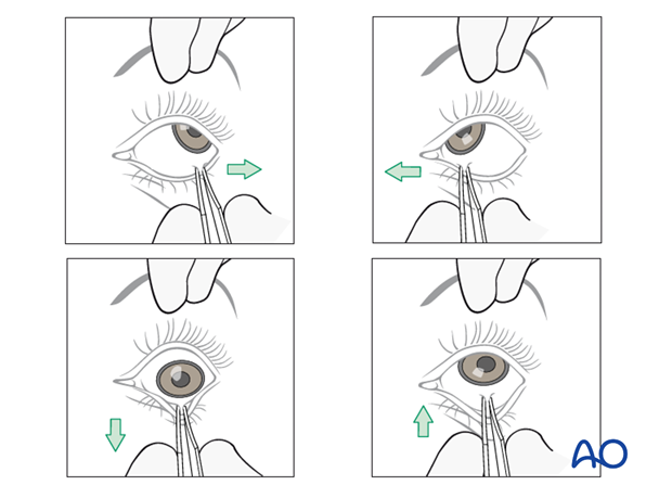 orbital reconstruction