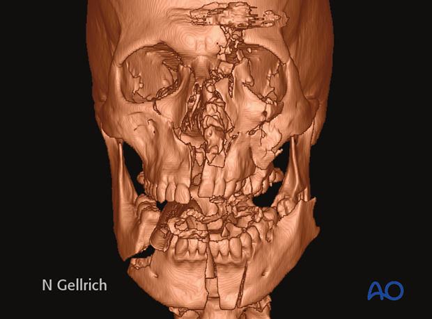 examination of patients with midfacial injuries