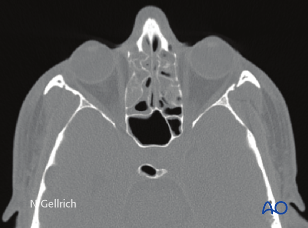 examination of patients with midfacial injuries