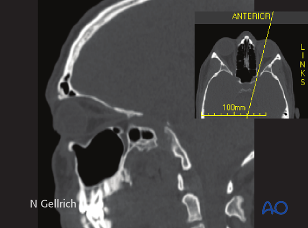 examination of patients with midfacial injuries