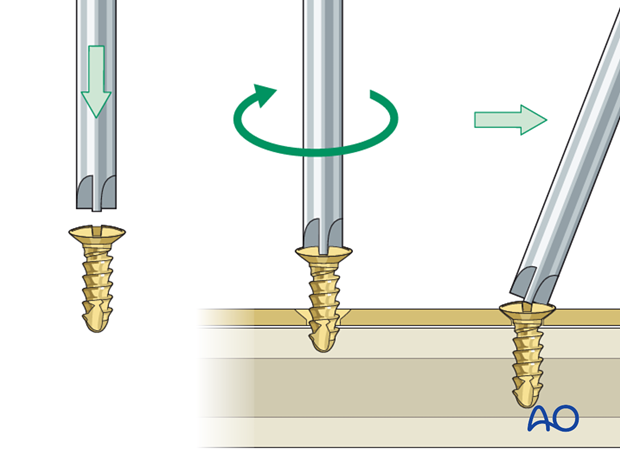 choice of implants