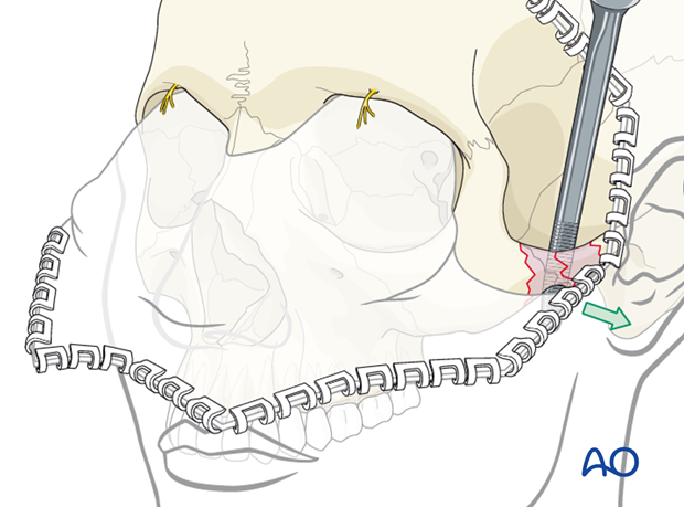 Fragments of the zygomatic arch are elevated under direct vision through the coronal approach