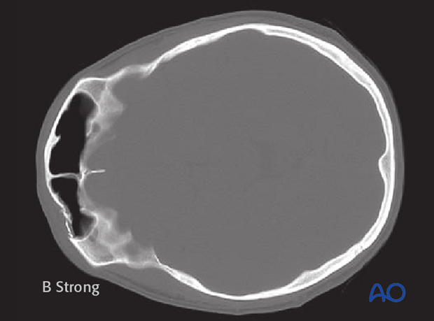 Endoscopic approach to the anterior table