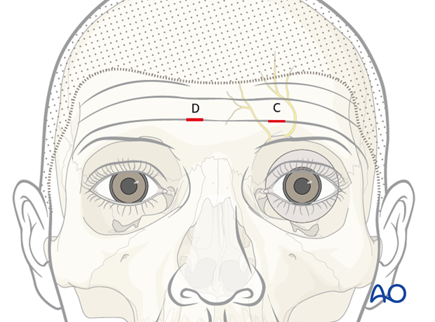 Endoscopic approach to the anterior table