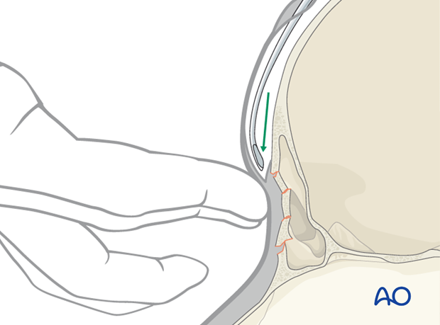 Endoscopic approach to the anterior table