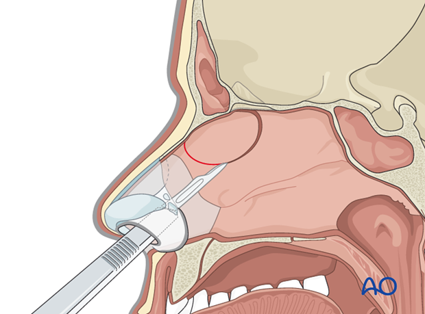 Endoscopic transnasal approach to the frontal sinus