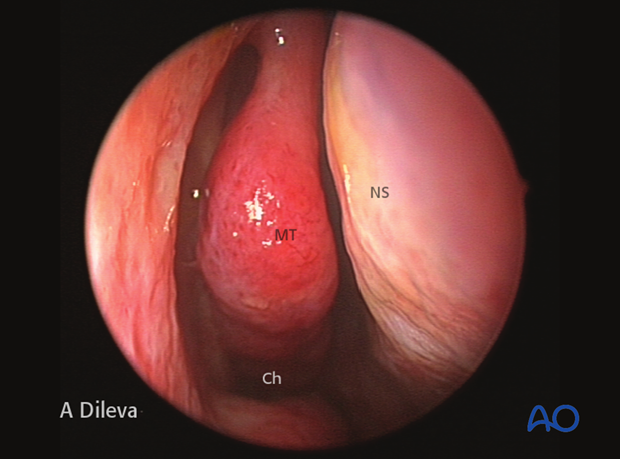 Endoscopic approach to the central skull base