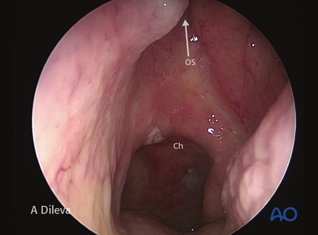 Endoscopic approach to the central skull base