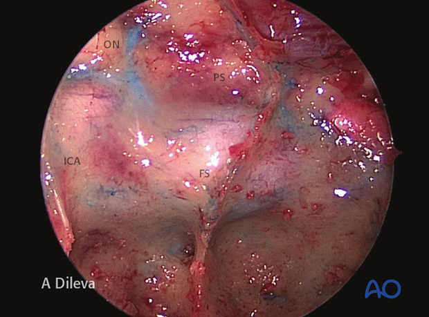 Endoscopic approach to the central skull base