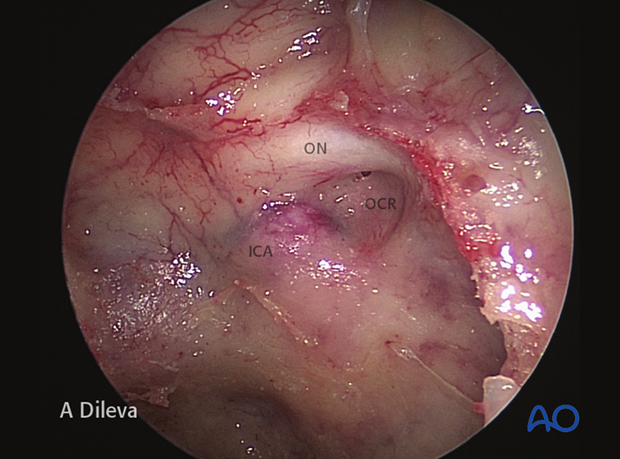 Endoscopic approach to the central skull base