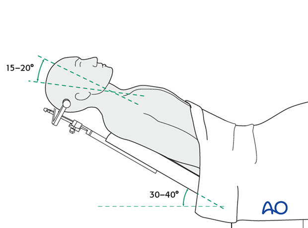 Coronal approach