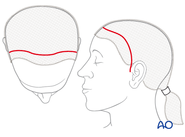 Anteriorly over the vertex placed incision