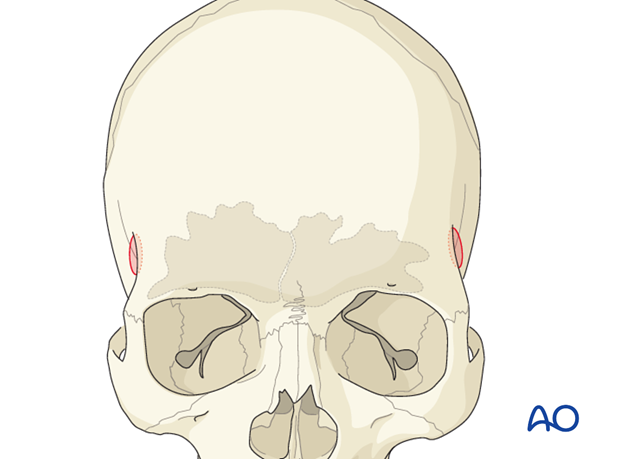 Craniotomy