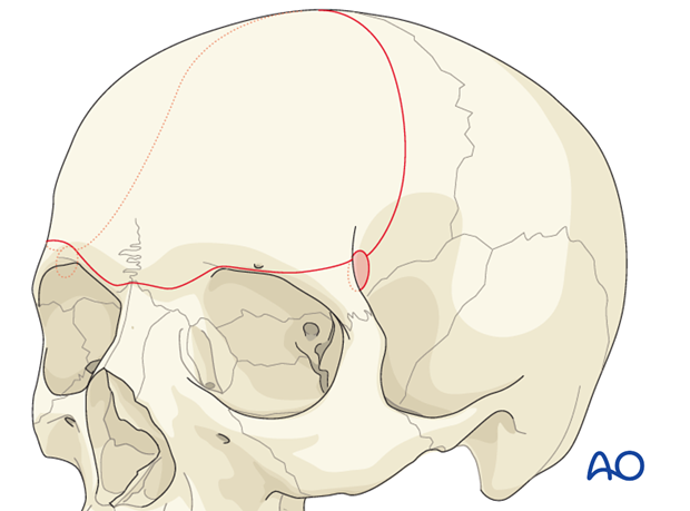 Craniotomy