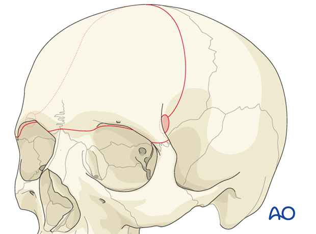 Craniotomy