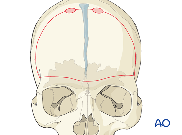 Craniotomy