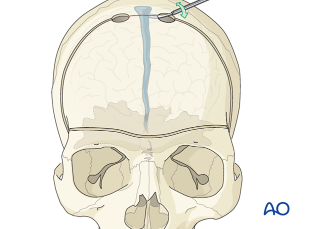 Craniotomy