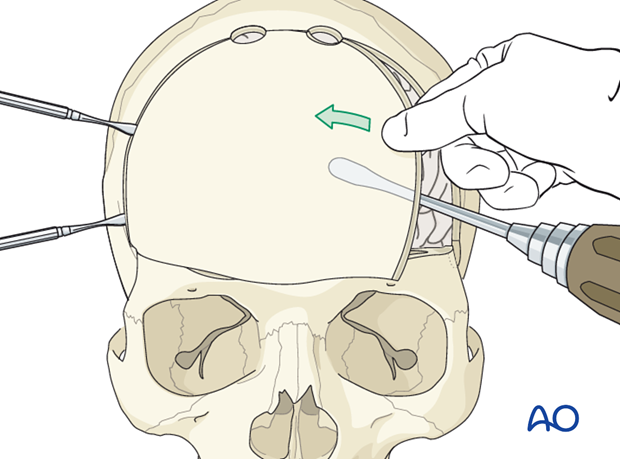 Craniotomy