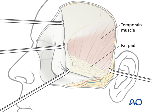 Lateral skull base approach