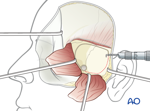 Lateral skull base approach