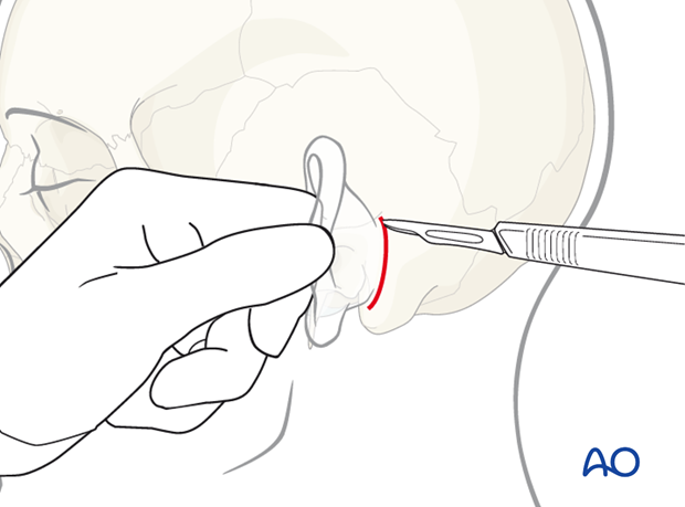 Postauricular incision