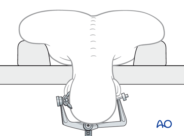 Posterior skull base approach