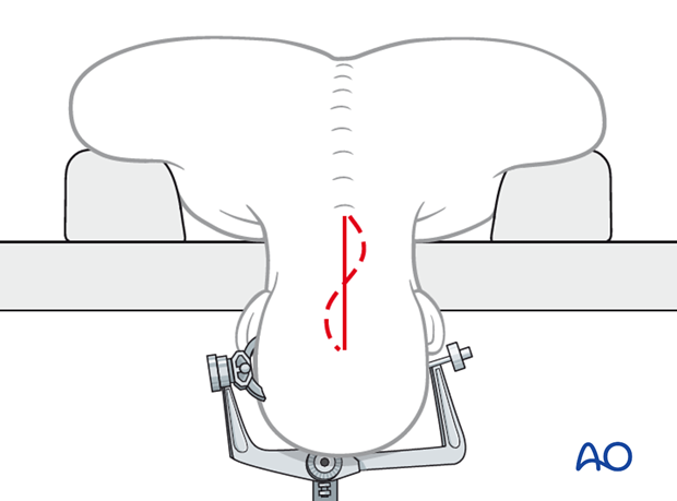 Posterior skull base approach