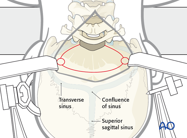 Posterior skull base approach