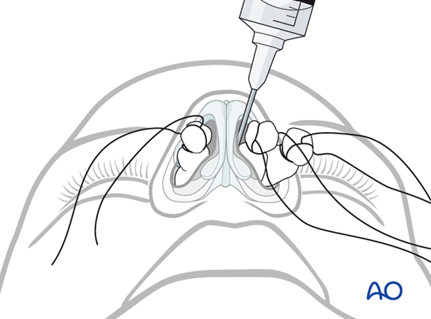 Endonasal approaches (transfixion incision and intercartilaginous incisions)