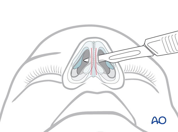 Endonasal approaches (transfixion incision and intercartilaginous incisions)