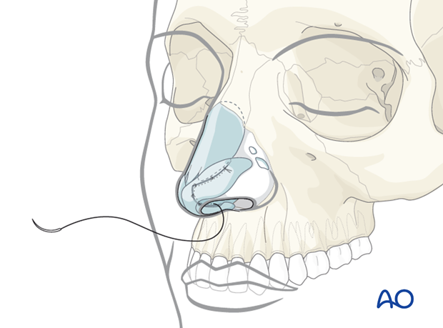 Endonasal approaches (transfixion incision and intercartilaginous incisions)