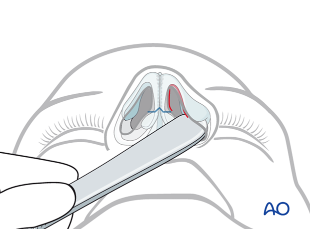 External rhinoplasty approach (open)