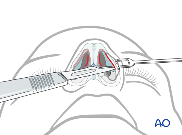 External rhinoplasty approach (open)