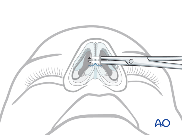 External rhinoplasty approach (open)