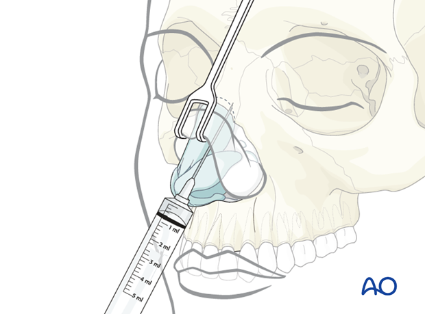 External rhinoplasty approach (open)