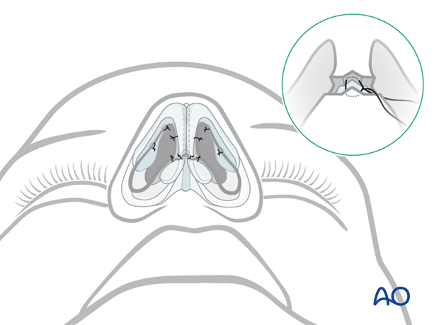 External rhinoplasty approach (open)