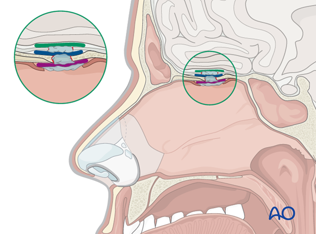 Endoscopic approach to the central skull base