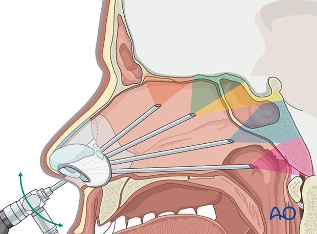 Endoscopic approach to the central skull base