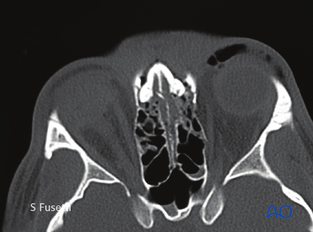 Diagnosis of NOE fractures