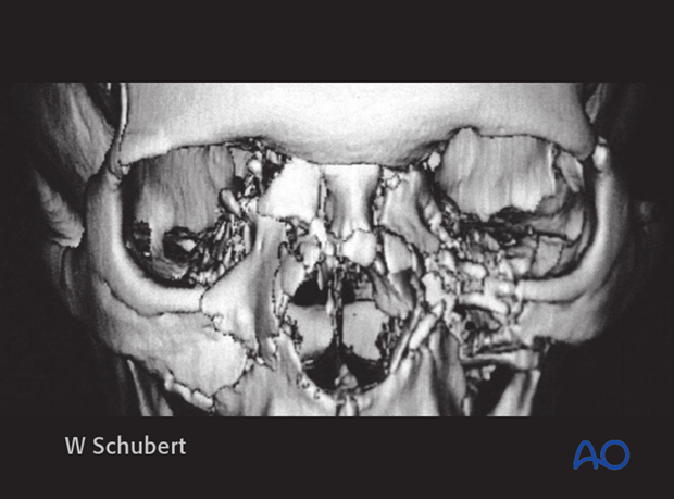 Diagnosis of NOE fractures