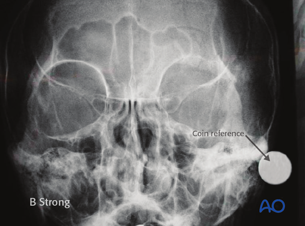 Defining the sinus margin