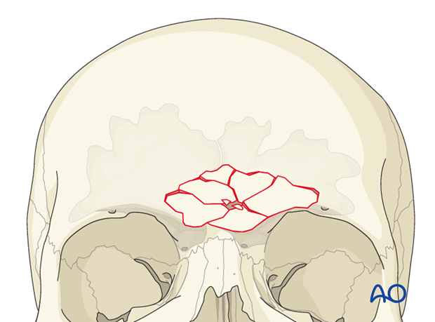 Defining the sinus margin