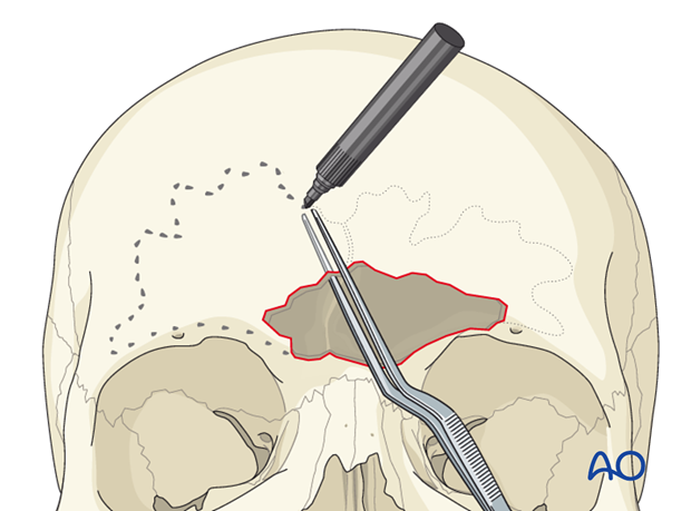 Defining the sinus margin