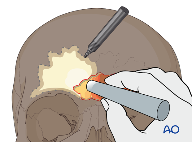 Defining the sinus margin