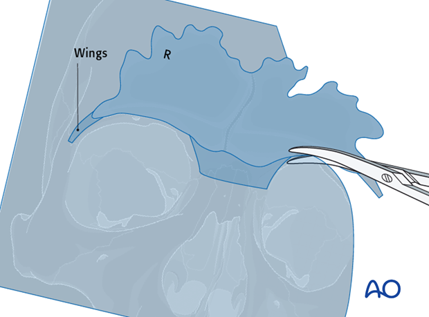 Defining the sinus margin