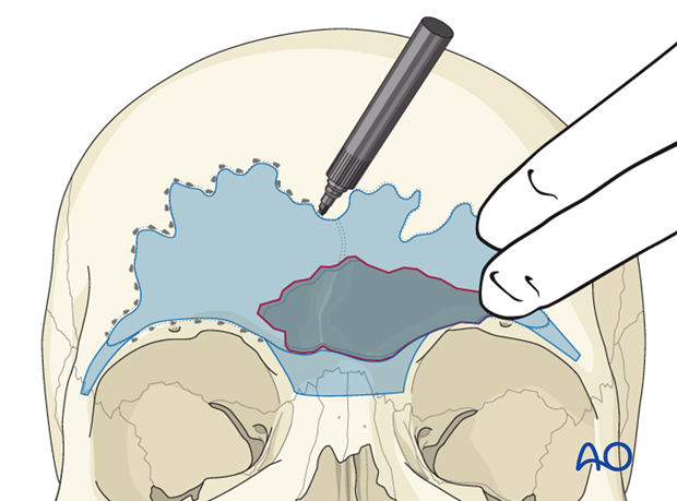 Defining the sinus margin