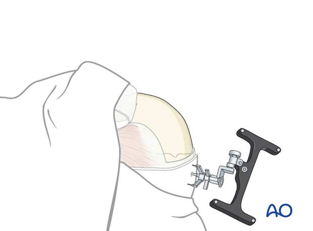 Defining the sinus margin