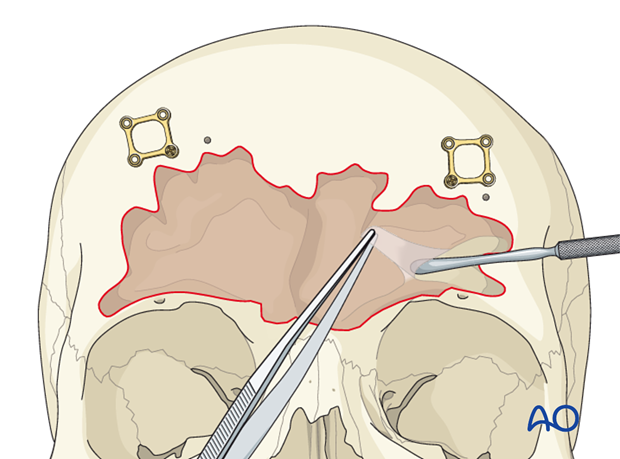 Mucosa removal